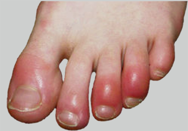 Chilblains