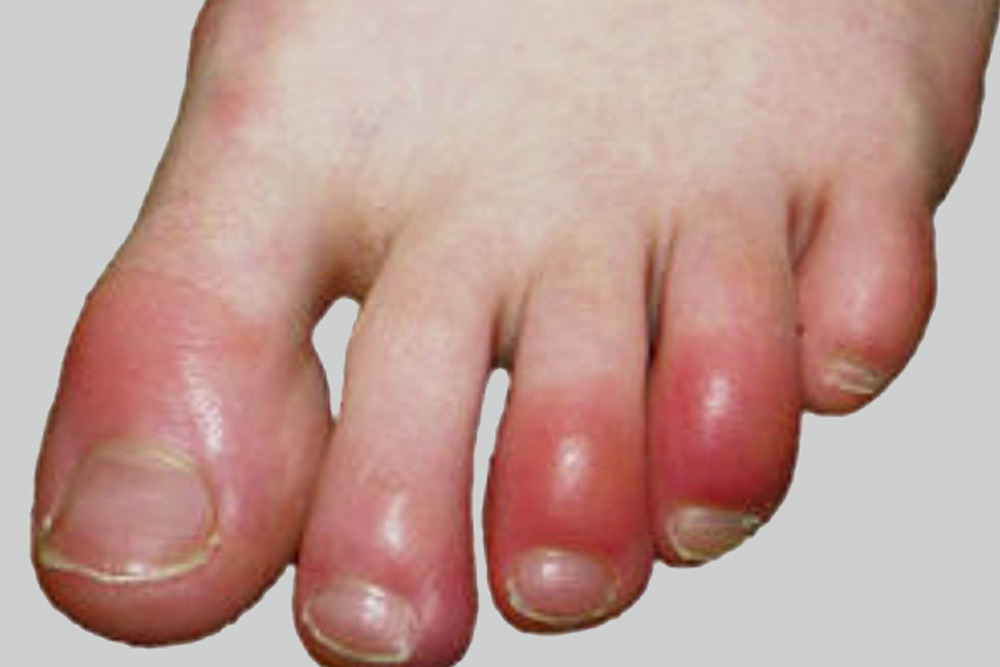 Chilblains Inflammation Melbourne Foot Clinic