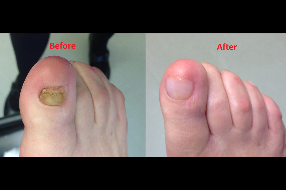 Keryflex Nail Restoration System Melbourne Foot Clinic Melbourne