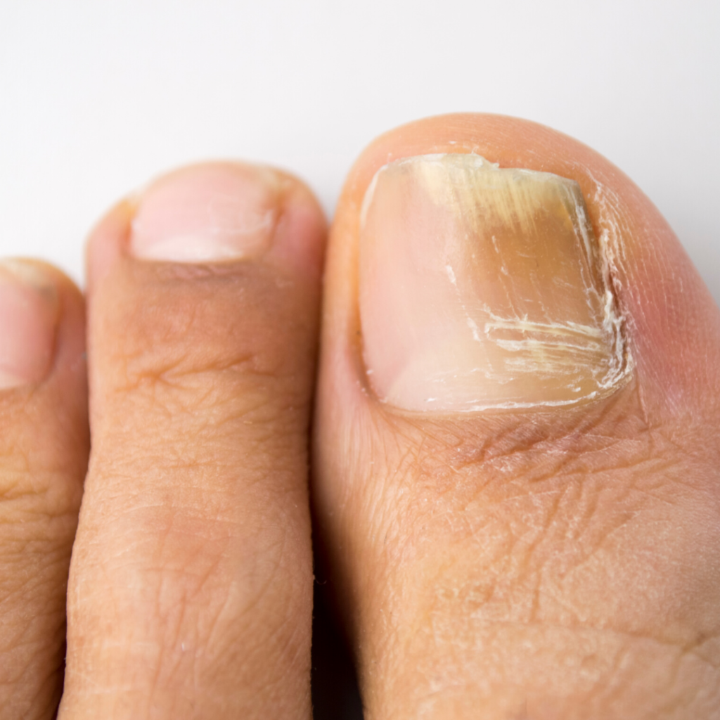 Ingrown Nail Surgery | Melbourne Foot Clinic | Melbourne Sports and ...