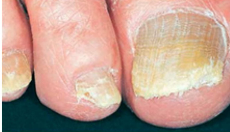 FUNGAL NAIL TESTING – Instant Testing and Results.