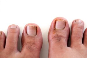 ingrown toenails can be treated with melbourne podiatrist at Melbourne Foot Clinic